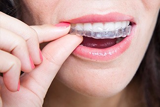 This is the image for the news article titled Life with Invisalign